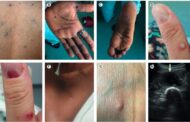 40% des patients atteints de la variole du Singe présentent des complications, selon une étude.