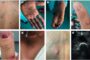 40% des patients atteints de la variole du Singe présentent des complications, selon une étude.